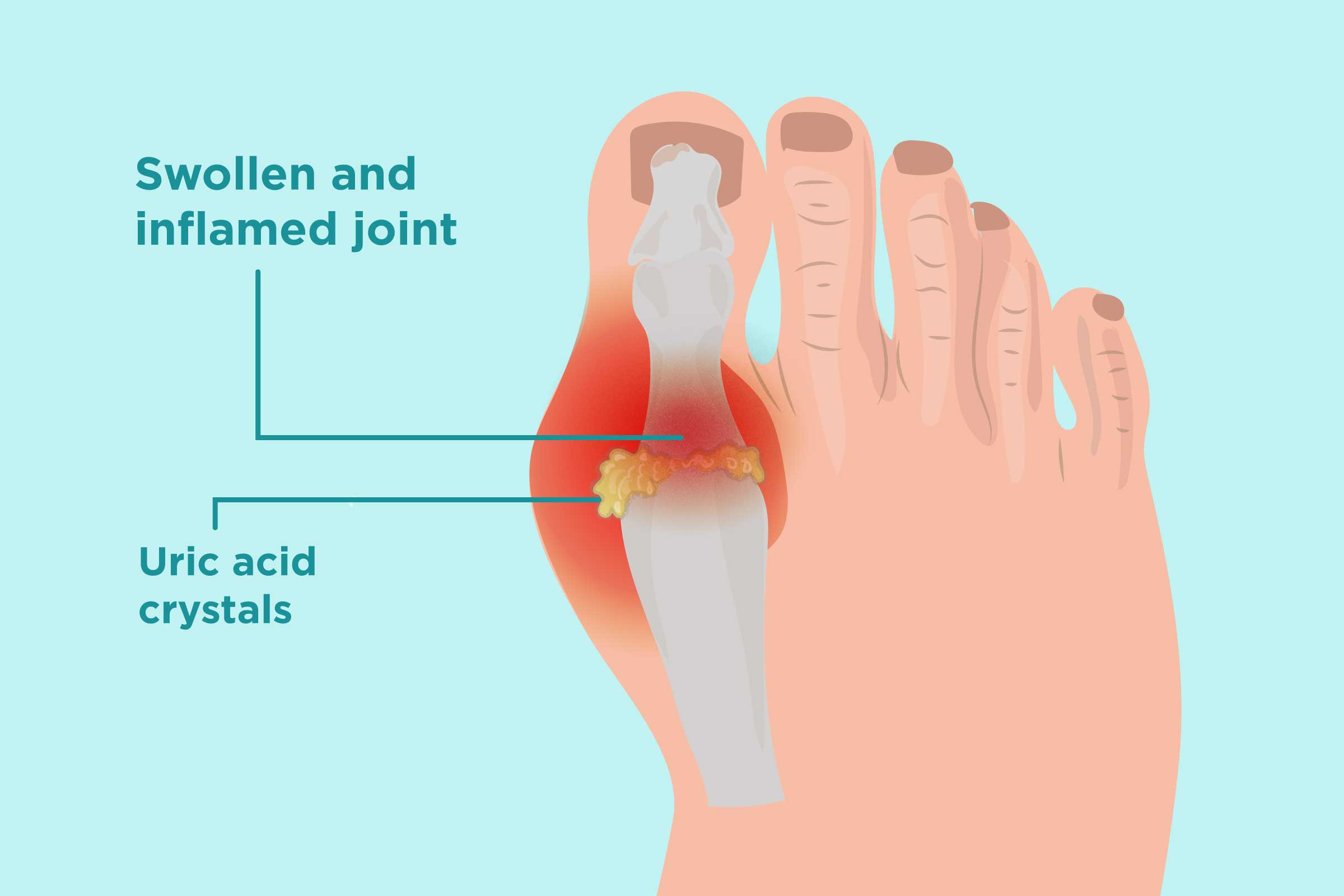 Did you know that CBD FLOWERS and CBD PRODUCTS are becoming very popular in EUROPE? today we are going to speak about how CBD FLOWERS and CBD PRODUCTS can help with gout