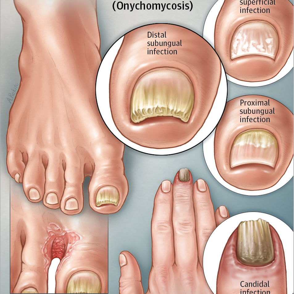 CBD and Fungal Nail Infection