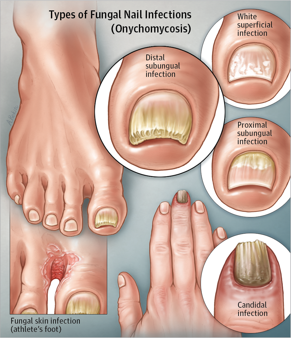 CBD and Fungal Nail Infection